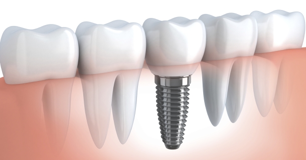 Zahn Implantate